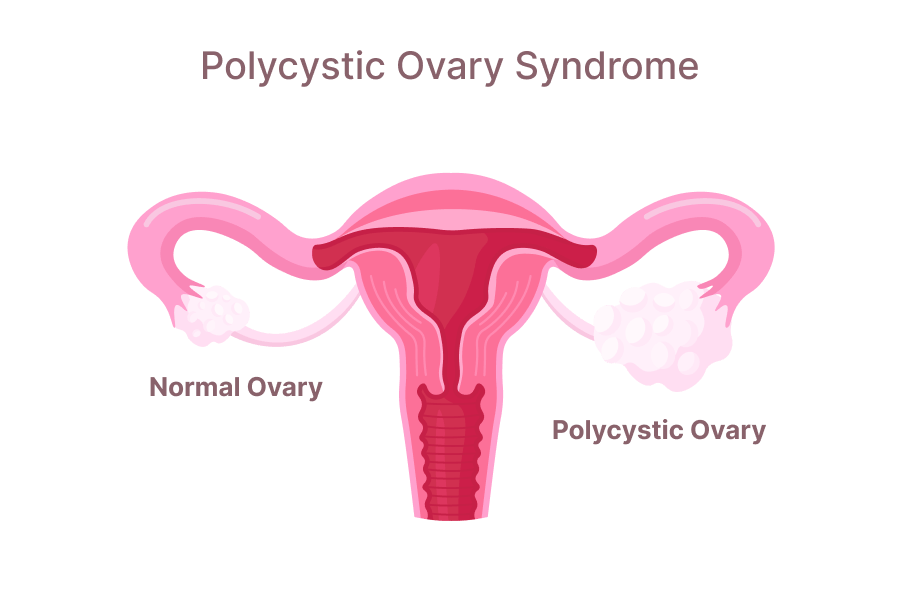 pcos belly