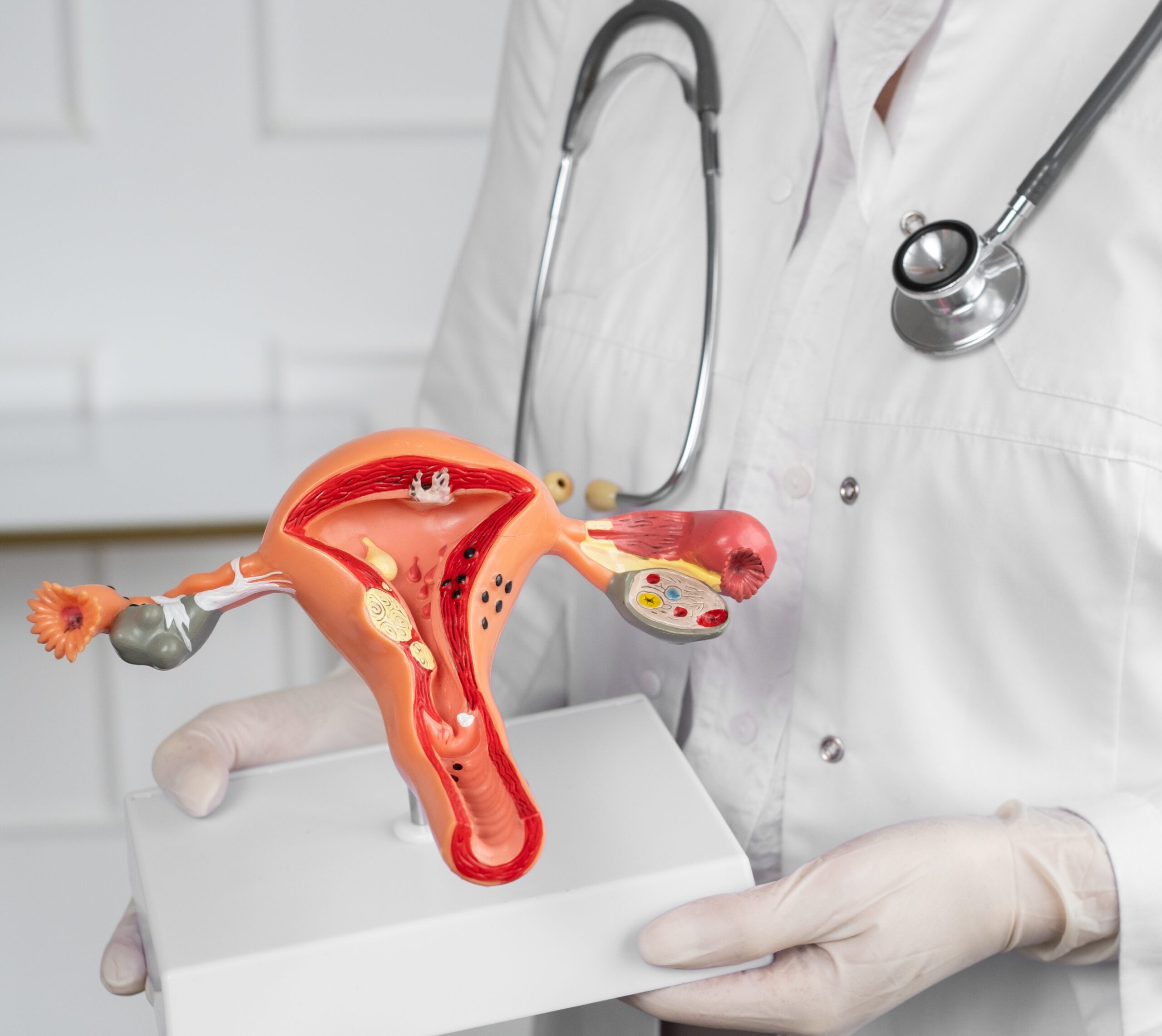 Natural remedies for pcos belly